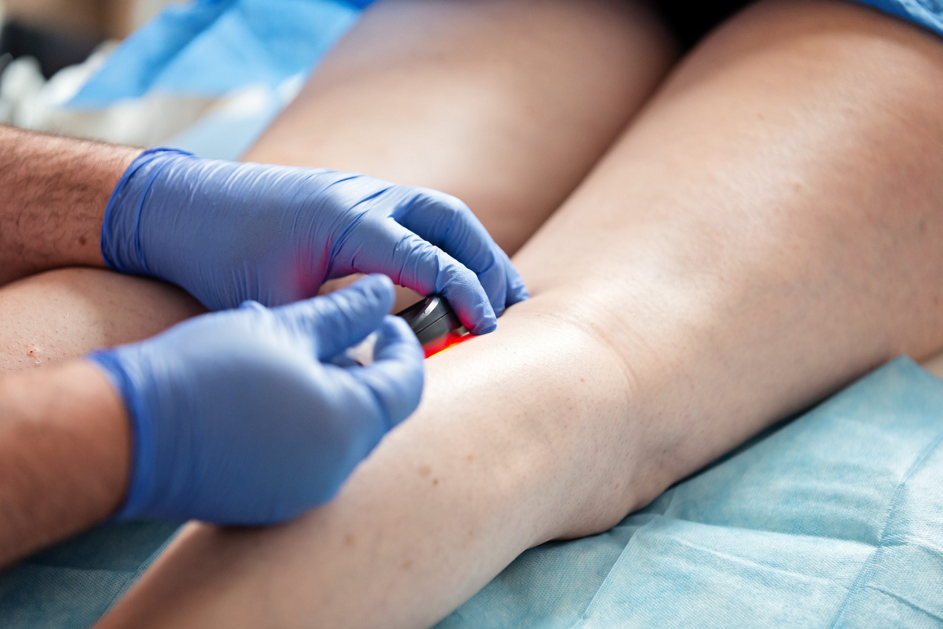 Sclerotherapy